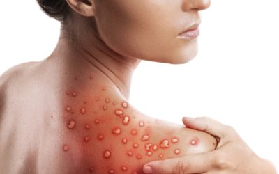 La Viruela del Mono (Mpox)