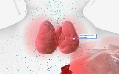 Hipotiroidismo Silencioso